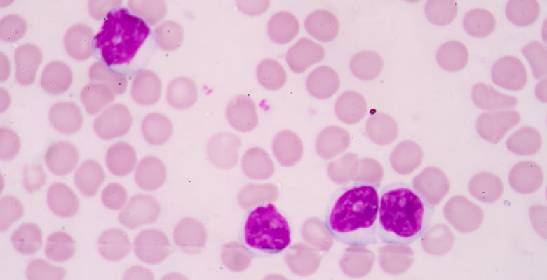 Estudo revela quatro novas associações genéticas na leucemia linfocítica crónica